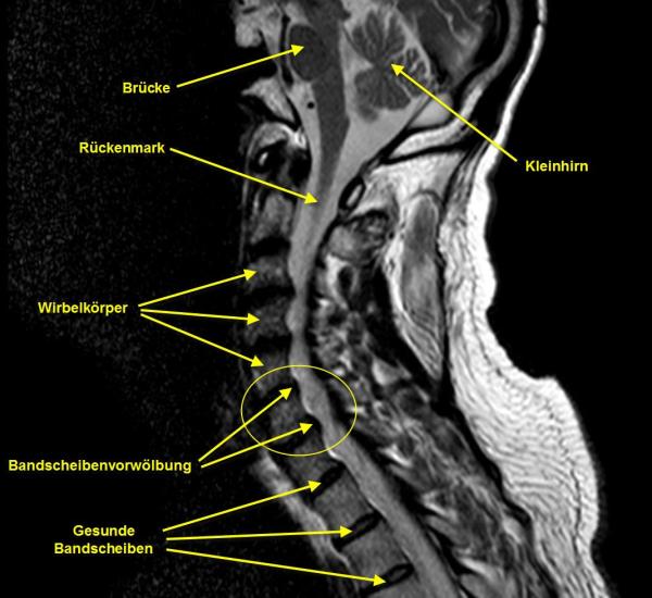 Bandscheibenvorwölbung